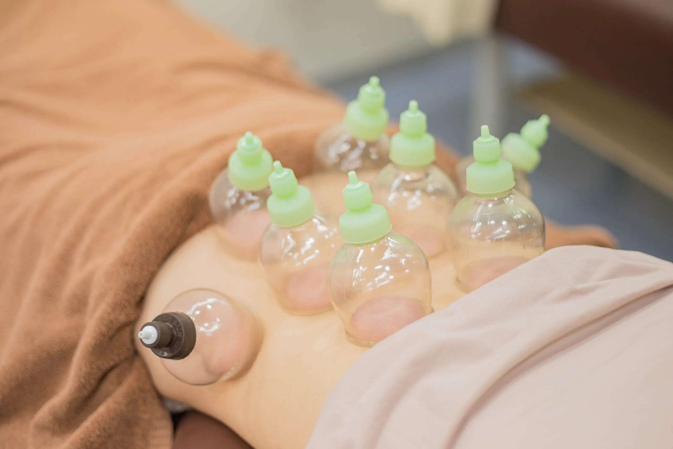 日本橋八重洲接骨院でのカッピング施術の様子